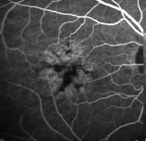 Ah Early And Late Phase Combined Fundus Fluorescein Angiography