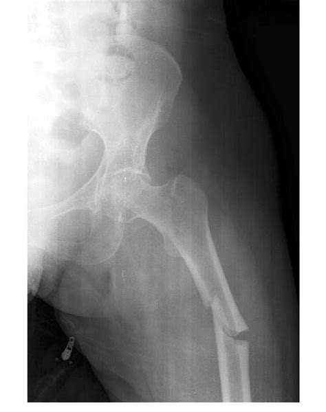 Radiograph Depicting A Proximal Femur Fracture With Features Indicating