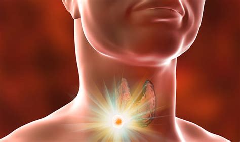 Throat Cancer Symptoms And Signs Are You At Risk Watch Out For A Sore