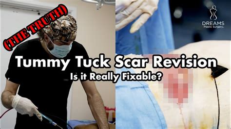Awake Tummy Tuck Scar Revision Youtube
