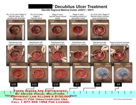 Decubitus Ulcer Treatment