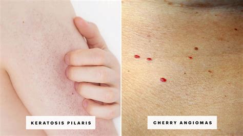 Tiny Red Blood Spots On Skin Pictures Petechiae Causes Treatments