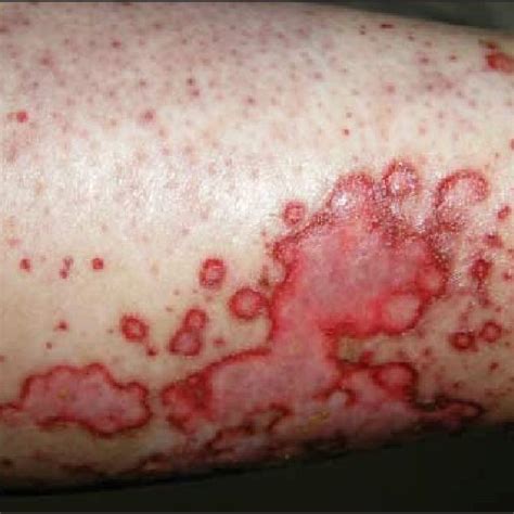 Diffuse Erythematous Purpuric Papules Partly Confluent In A Linear Or