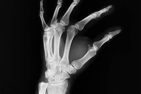 Wrist Fractures Treatment Casting Orthotics Plus Melbourne