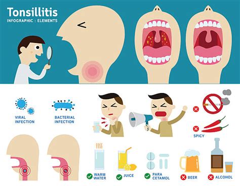 Royalty Free Tonsillitis Clip Art Vector Images And Illustrations Istock