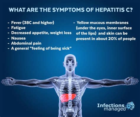What Are The Symptoms Of Hepatitis C Infections Managed
