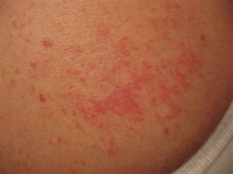 Pictures Of Diabetes Rash In The Leg Combination Medication For Type Diabetes
