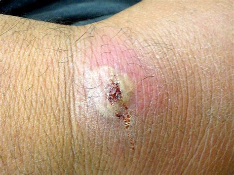 Deadly Skin Infection 12 Graphic Photos That Could Save Your Life Photo 1 Pictures Cbs News