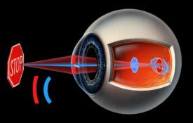 Secondo la posizione che le linee focali del conoide di sturm occupano rispetto alla retina, l'astigmatismo può essere semplice, composto o misto. A látás élettana