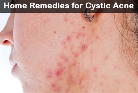 Cystic Acne Remedies