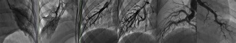 Angiografía Pulmonar En Cuña Magnificada Donde Se Puede Observar