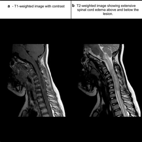 Preoperative Sagittal MRI Of The Cervical Spinal Cord A T Weighted Download Scientific