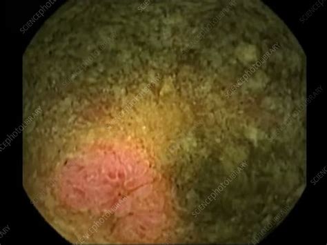 Ulcerated Stricture In Crohns Disease Endoscopy Footage Stock Video