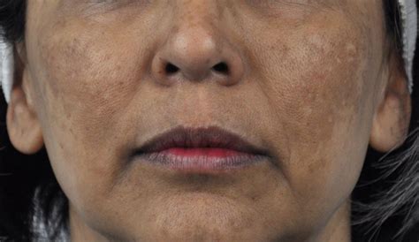 Sudden Freckles Or Melasma A Primer On The Skin Condition You Just