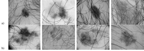 Examples Of Dermatoscopic Images Of Skin Lesions Containing Hair