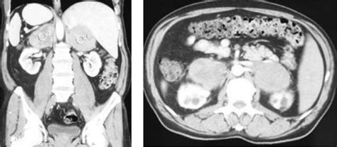 Abdominal Ct Scan Showing Large Bilateral Adrenal Masses Download