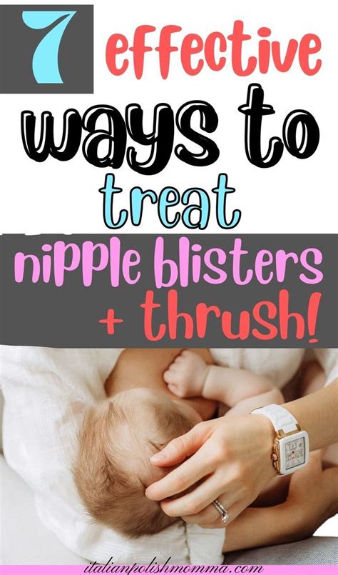 7 Effective Ways To Treat Milk Blisters And Thrush Naturally Artofit