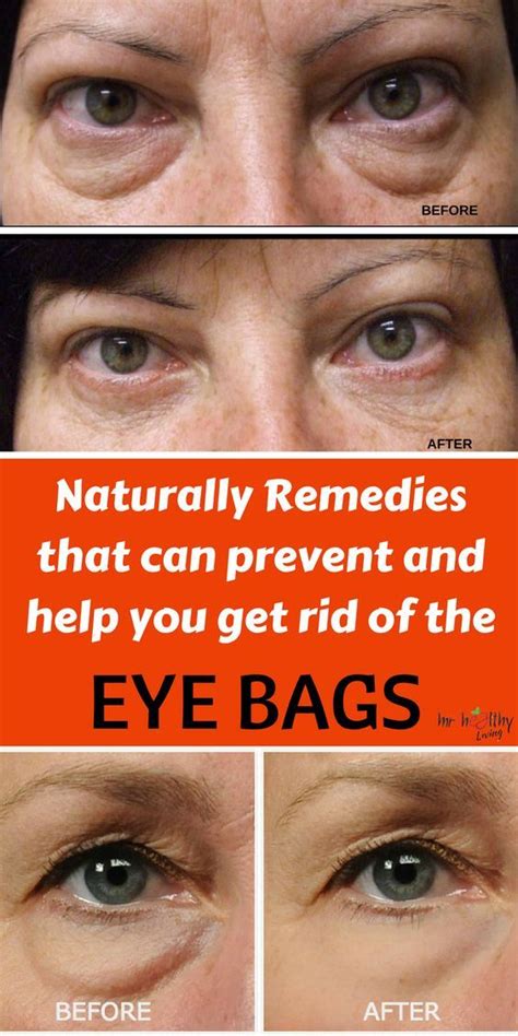 List Of How To Get Rid Of Dark Eye Bags In Minutes References Jangan