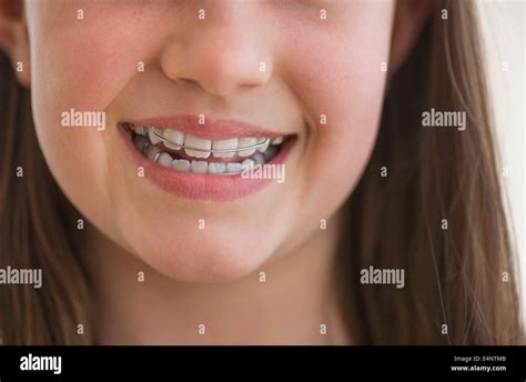 Mädchen 10 11 Trägt Dental Zahnspange Lächeln Stockfotografie Alamy