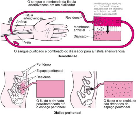 Hemodiálise é Diálise Diferença