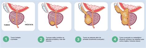 Saiba mais sobre o câncer de próstata Janssen Brasil
