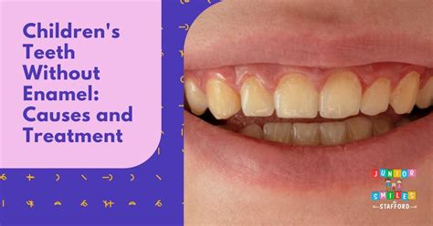 Childrens Teeth Without Enamel Causes And Treatment Junior Smiles