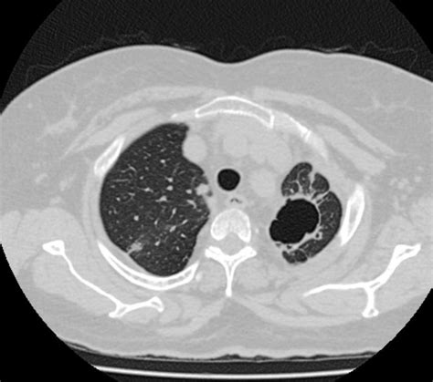 A Rare Cause Of Multiple Cavitating Pulmonary Nodules Pyoderma