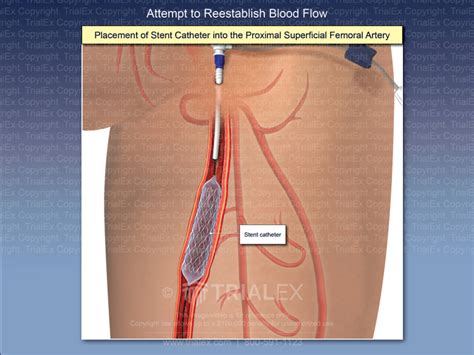 Placement Of Stent Catheter Into The Proximal Superficial Femoral