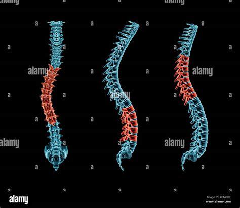 Diseases Of The Spine Scoliosis Lordosis Kyphosis Body Posture Sexiz Pix