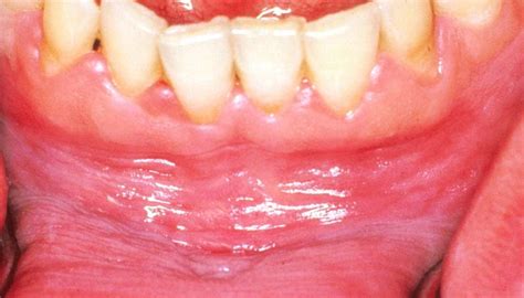 White Gums Causes Symptoms And How To Get Rid Of Them