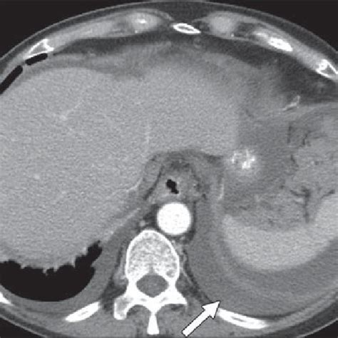 Year Old Woman With Stage Iiic Ovarian Cancer Axial Ct Image Shows