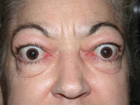 Medical Pictures Info – Proptosis