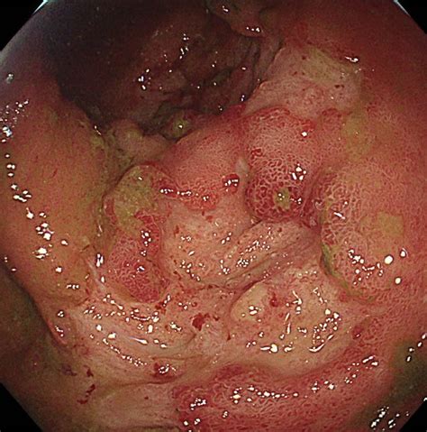 Keith Siau On Twitter Views Of The Proximal Colon In A Patient With
