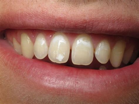 White Spots From Braces Cosmetic Bonding Before And After Gallery