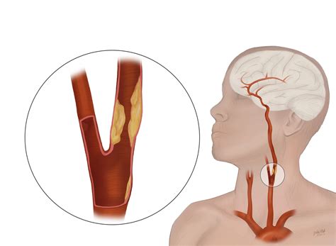 Arteries In Neck Arteries In The Neck The Carotid Arterial System