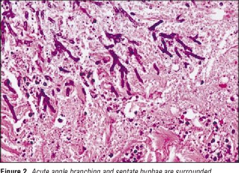 Figure 3 From Cutaneous Aspergillosis And Acquired Immunodeficiency