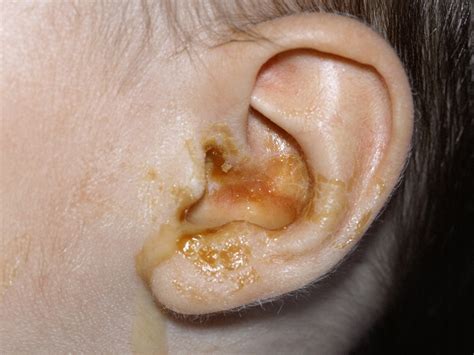 Baby Ear Infections Signs Symptoms And Treatment Babycenter