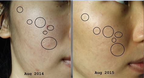 Treatment Depressed Acne Scars After Dermarolling At Home Cindity