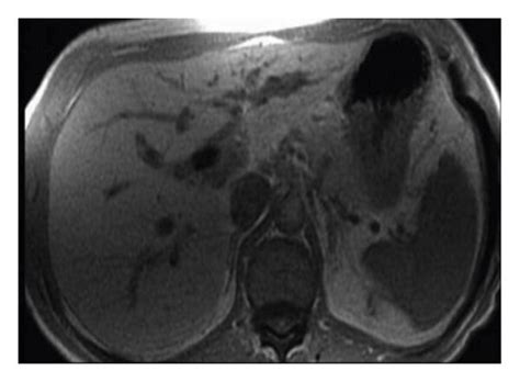 Perihilar Cholangiocarcinoma A An Mrcp Image As A Focal Stricture