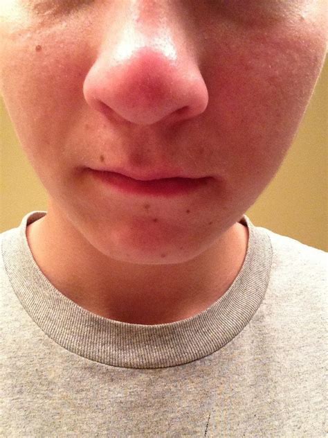 Nose Got All Swollen And Sore Overnight Anyway I Can Pop It Please