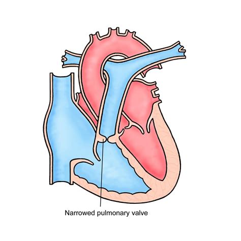 Pulmonary Stenosis Interactive Health