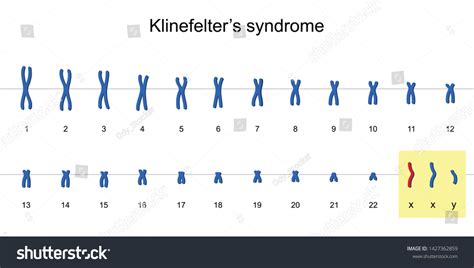 Klinefelters Syndrome Karyotype Nondisjunction Sex Chromosomes Vector