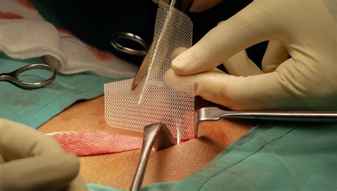 No single technique avoids both of these main complications. Trial Dates Set for Bard Hernia Mesh Cases | Drug And Device Watch