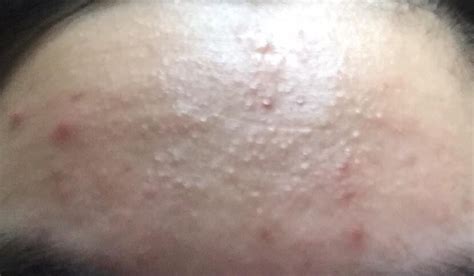 Skin Concerns Help Please In Treating This These Bumps Suddenly