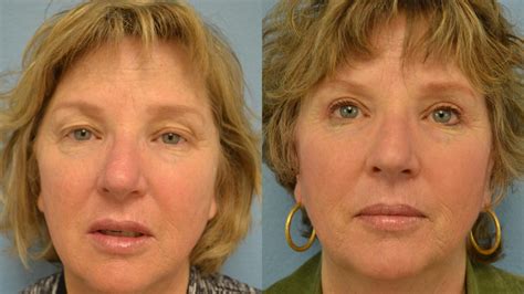 Eyelid Surgery Before And After Photos Patient 143 San Francisco Ca
