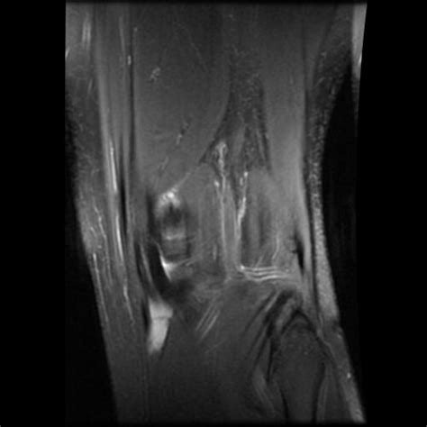 Hover on/off image to show/hide findings. Houston Texas MRI or Magnetic resonance imaging Of my torn ACL in my Left Knee 2009 Photos ...