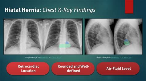 Hiatal Hernia Explanation Of Chest X Ray Findings Youtube