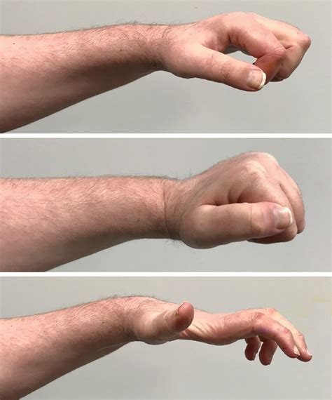 Reanimating Hand Function After Spinal Cord Injury Using Nerve Transfer