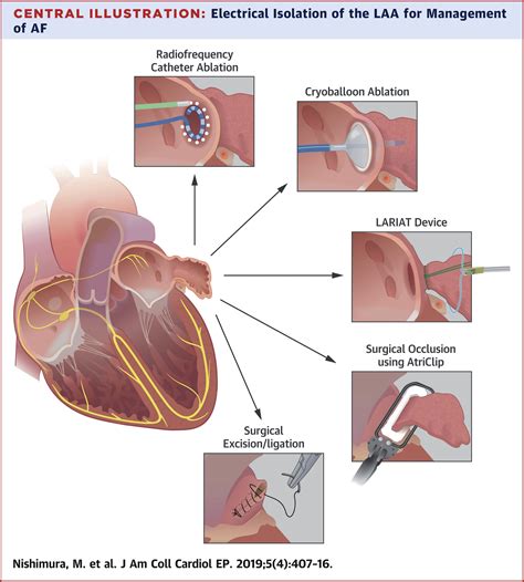 Left Atrial Appendage Electrical Isolation As A Target In Atrial