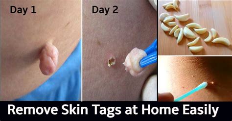 3 home remedies to get rid of skin tags skin tag removal